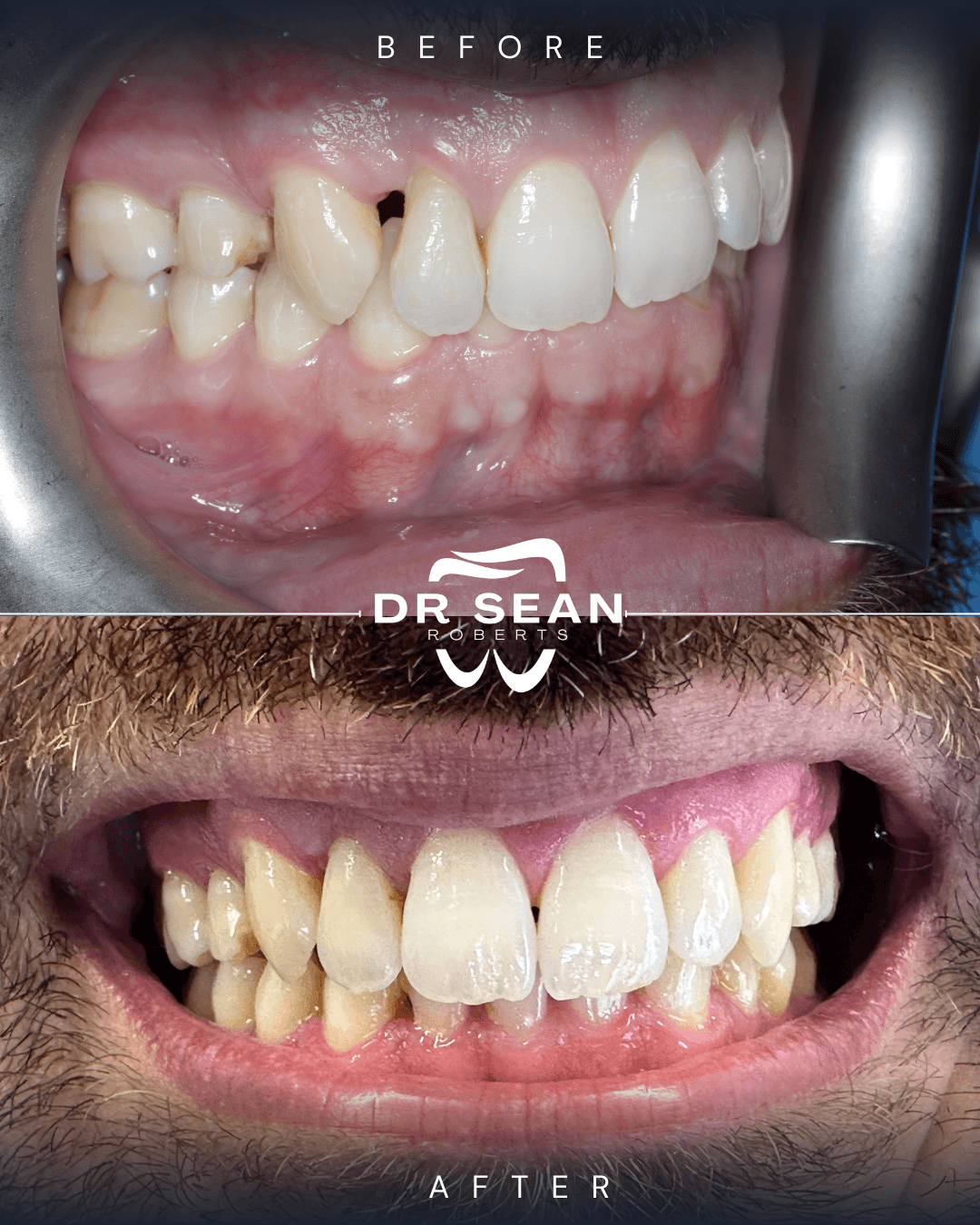 Smile transformation 3