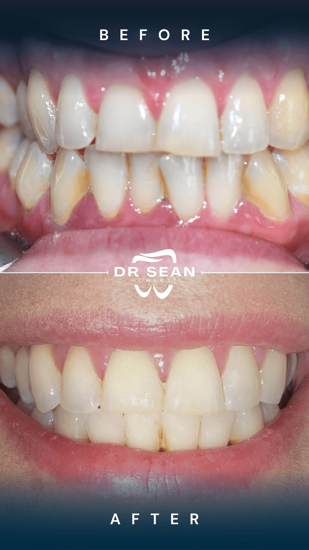 Smile transformation 4