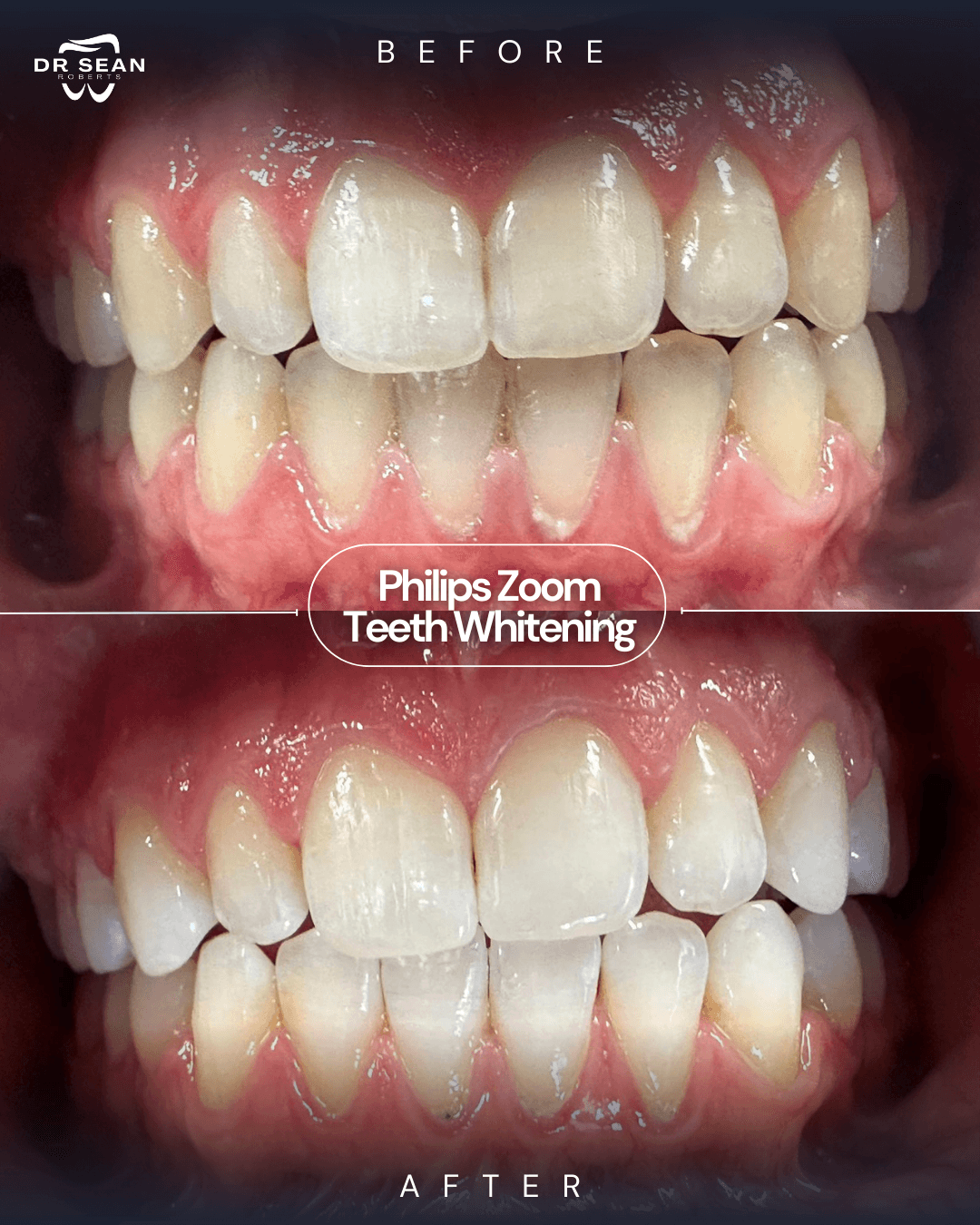 Smile transformation 6