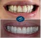 Porcelain Veneers