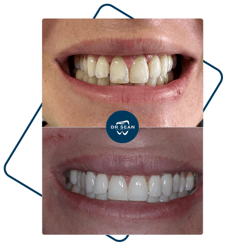 Invisalign results