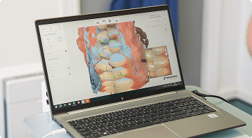 3D digital dental scan displayed on a laptop for dental treatment planning