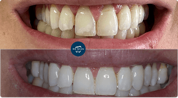 Before and after close-up of front teeth in Dr Sean Roberts' porcelain veneers gallery