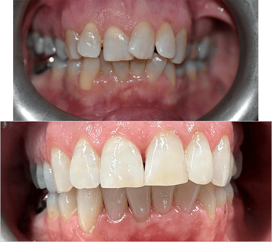 Before and after front teeth transformation from Dr Sean Roberts' smile gallery